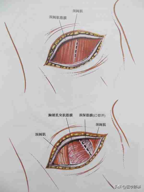 颈椎前路手术