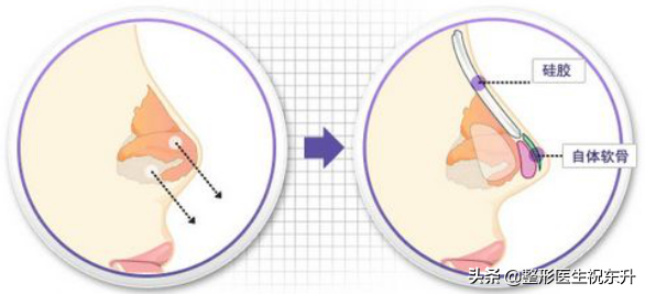 关于"假体隆鼻"，你担心的风险都在这里