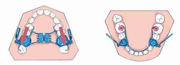 牙齿矫正中的“扩弓”，究竟是什么？