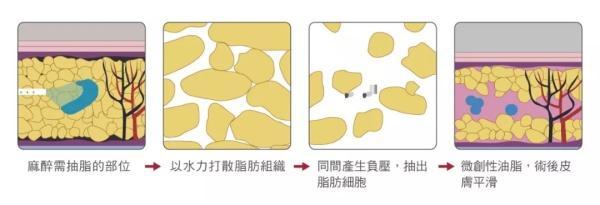 口袋喵科普贴：夏季露胳膊露腿，抽脂风险指南