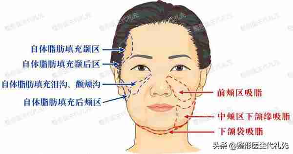 面部局部吸脂，主要采用哪几种方式？