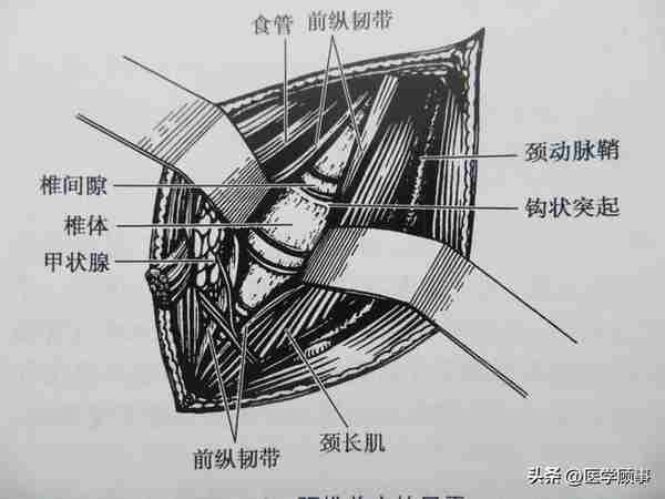 颈椎前路手术